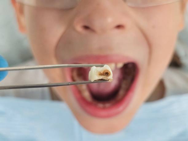 Best Emergency Broken Tooth Repair in Tusculum, TN